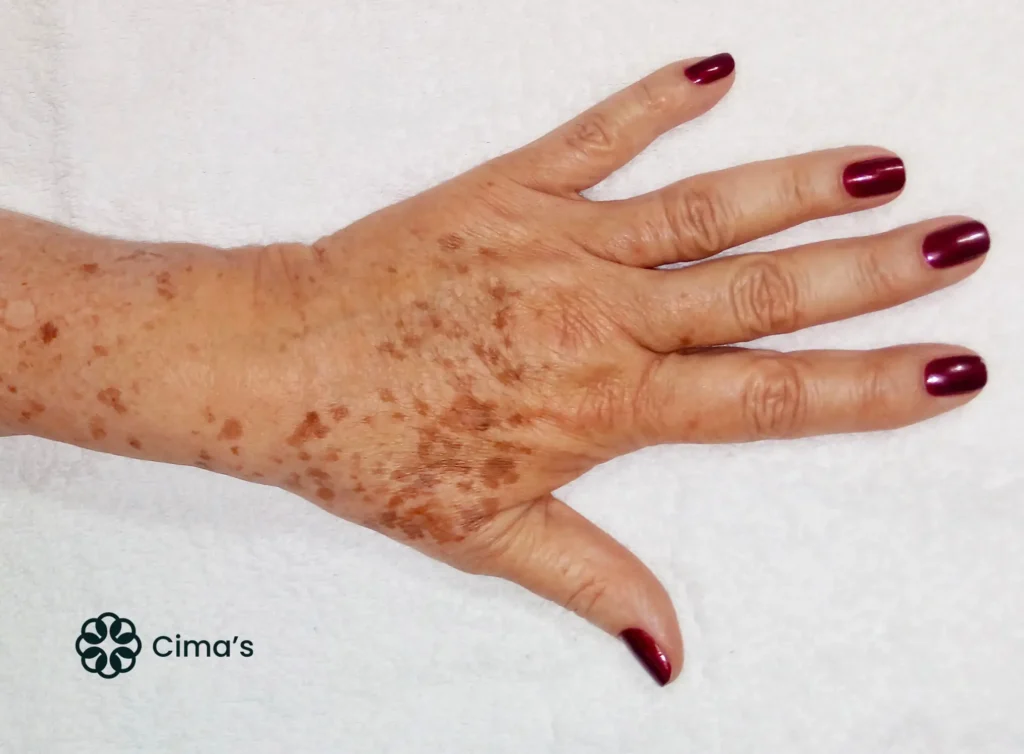 Diferenciando Manchas Senis de Outros Tipos de Alterações na Pele - inspiração 1