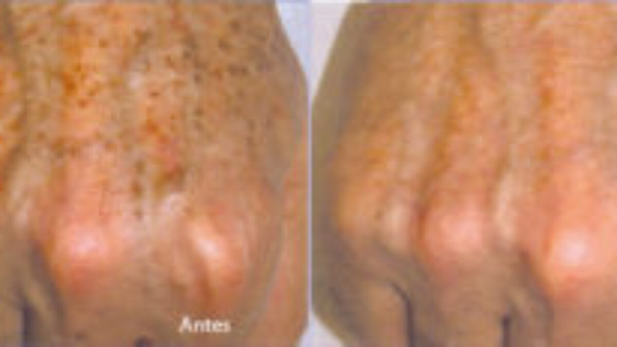 Tratamentos a Laser e Luz Pulsada: Soluções Mais Intensivas - inspiração 2