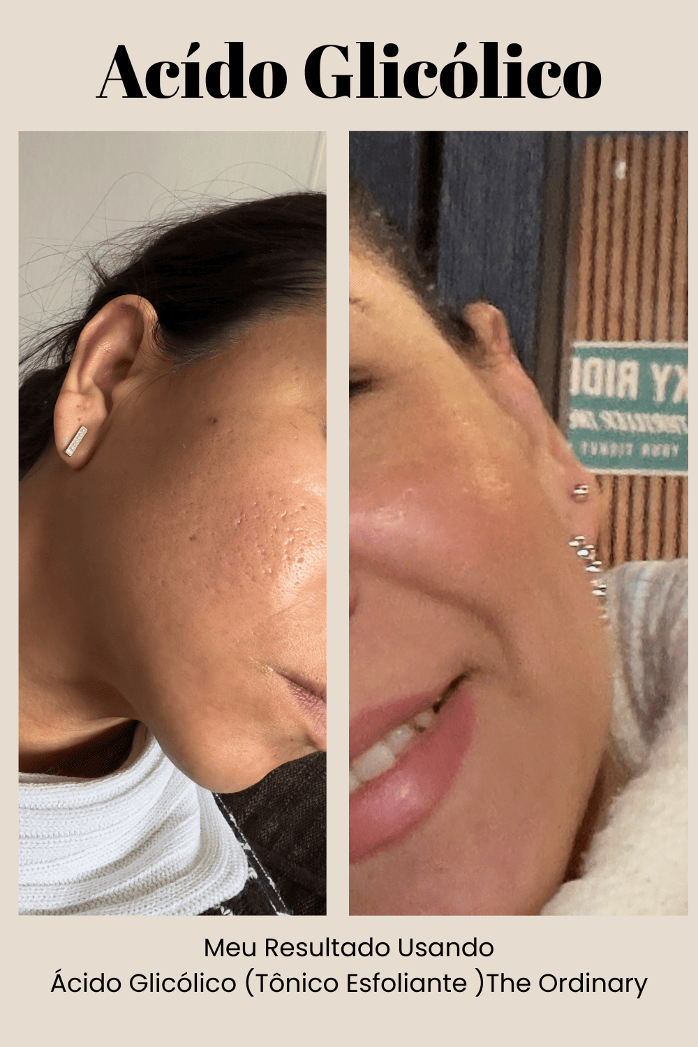 Começando com o Ácido Glicólico: Os Primeiros Passos Seguros - inspiração 2