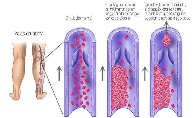 Dicas Extras Para o Bem-Estar a Bordo: Longe da Trombose - inspiração 2