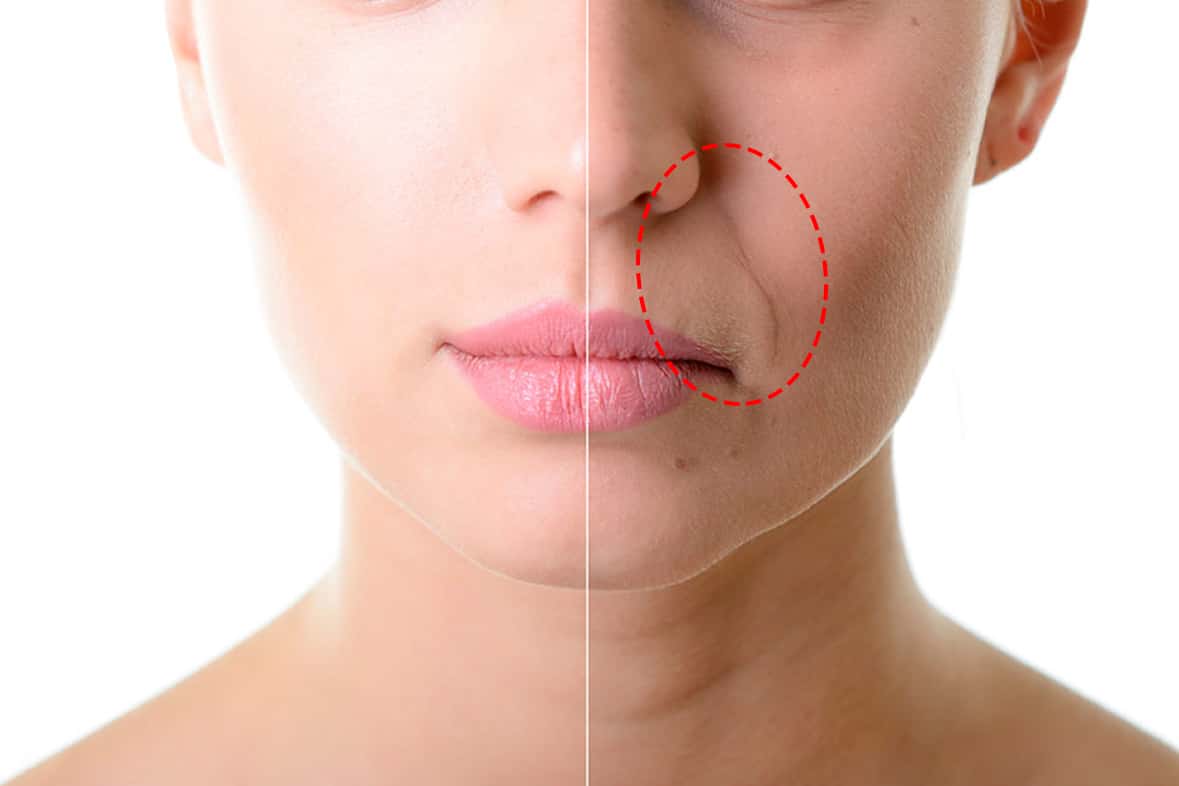 prevenção bigode chinês