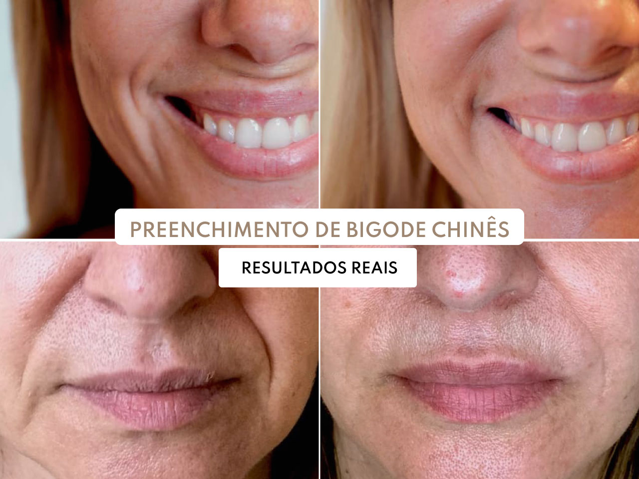 melhor tratamento bigode chinês