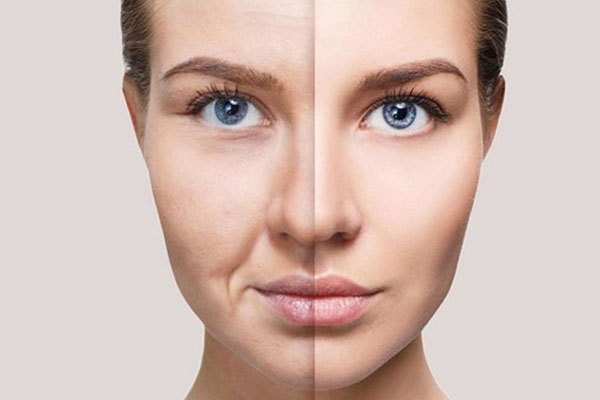 flacidez facial