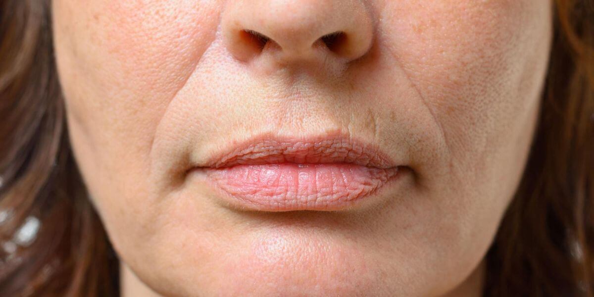 perda de volume facial