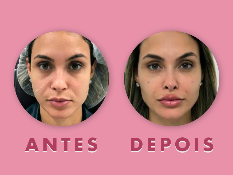 tratamento para bigode chinês