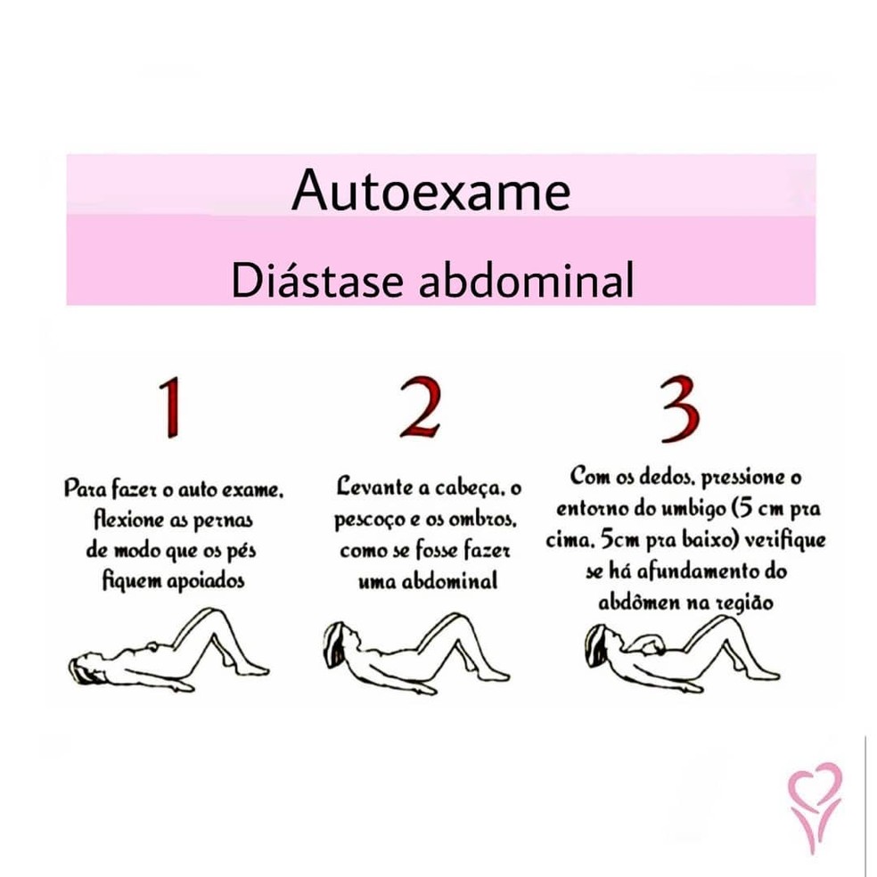 Como Identificar e Tratar a Diástase Abdominal
