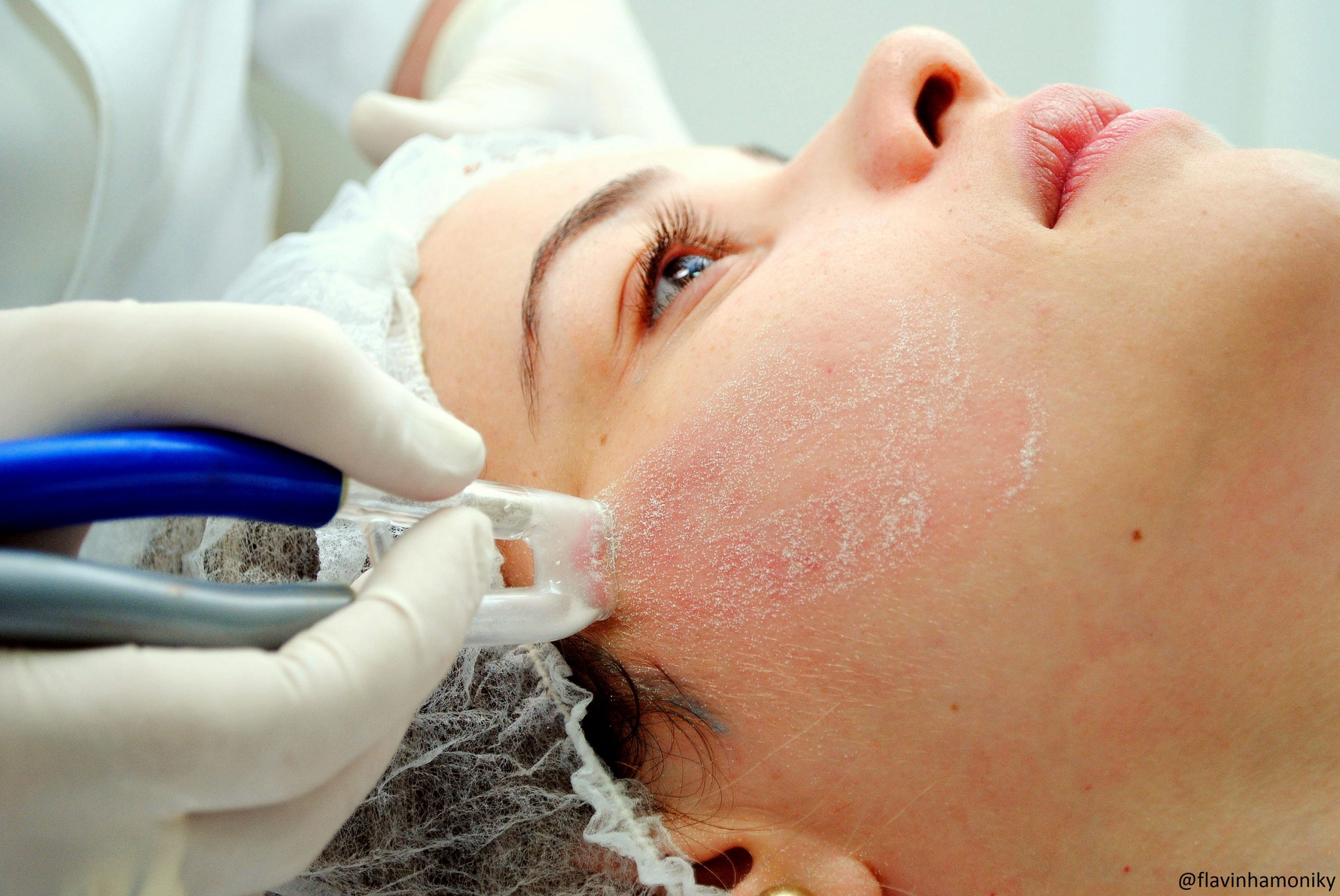 alternativas ao peeling de cristal profissional