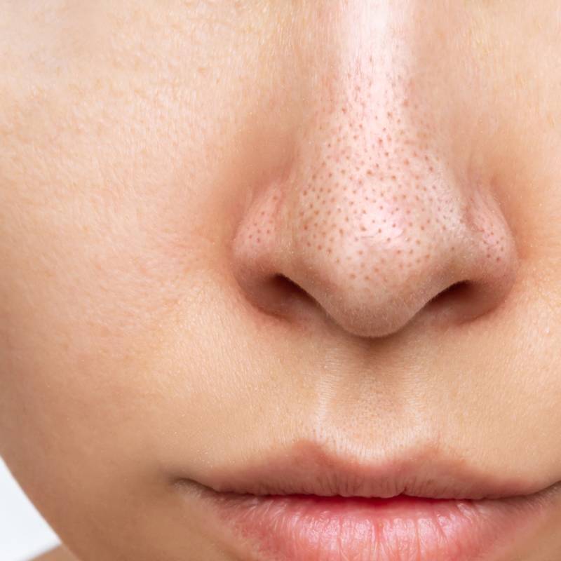 como remover cravos do nariz sem machucar