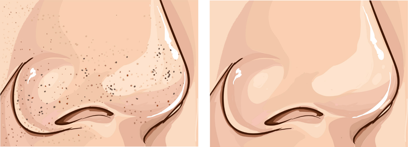 como remover cravos do nariz sem machucar