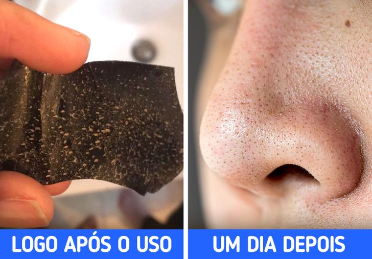 Como remover cravos do nariz sem machucar a pele