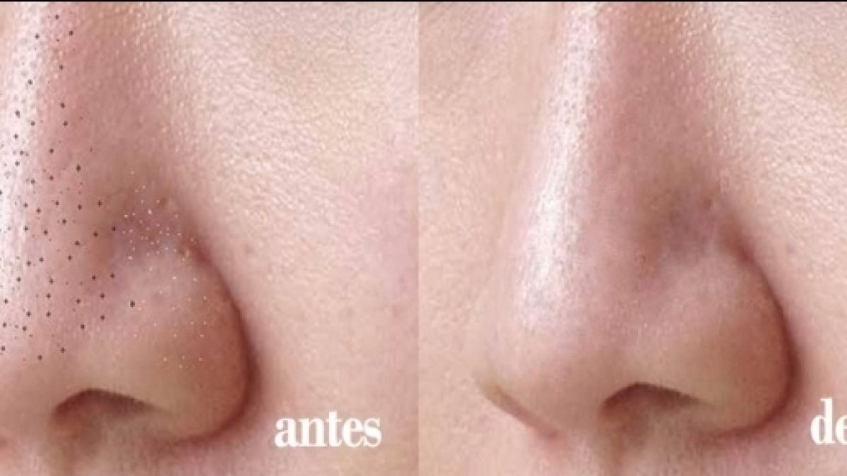 como remover cravos do nariz sem machucar