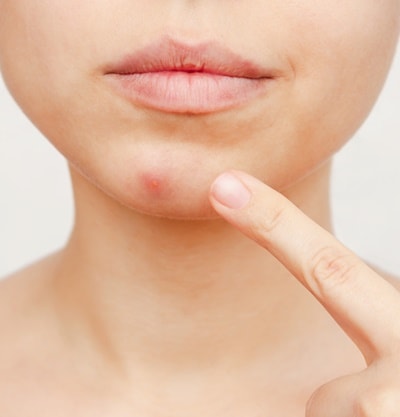 como tratar cravos pretos persistentes no queixo