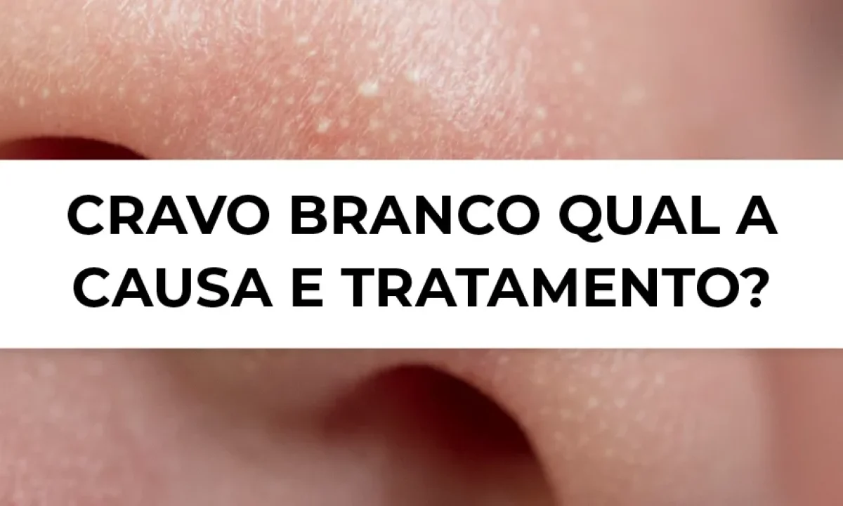 rotina de skincare para cravos no queixo