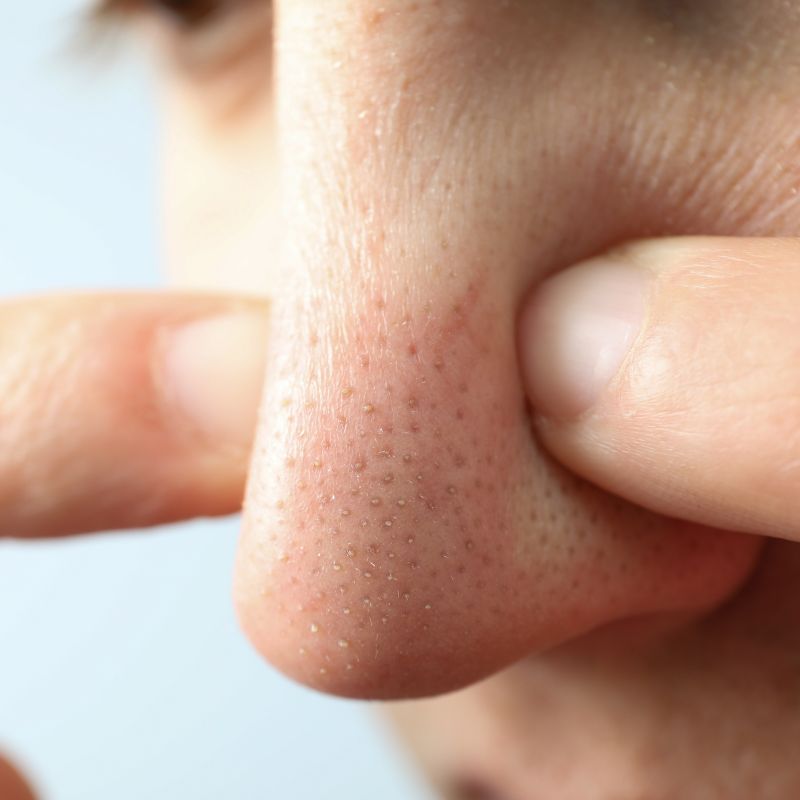 rotina de skincare para cravos no queixo