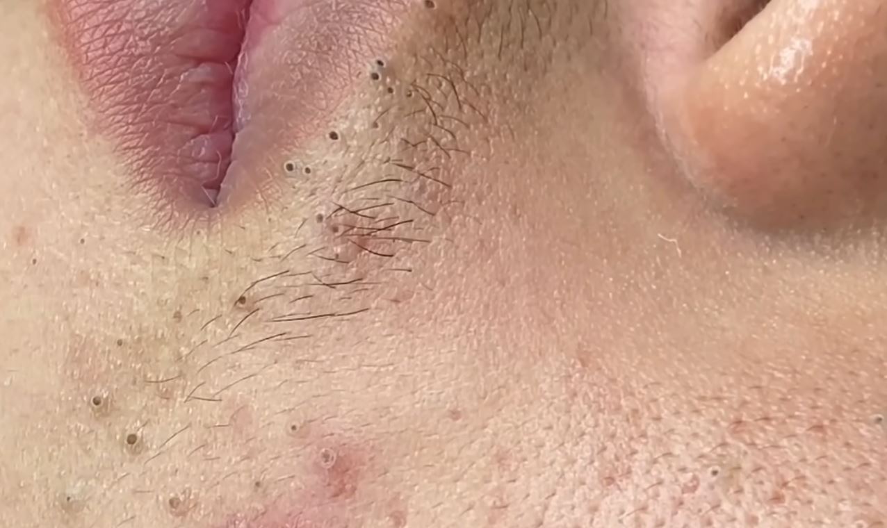 rotina de skincare para cravos no queixo