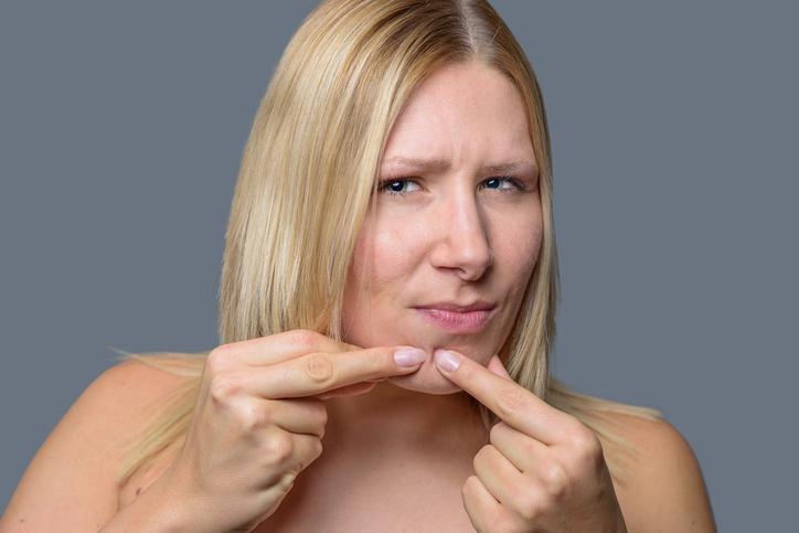 Como tratar cravos pretos persistentes no queixo