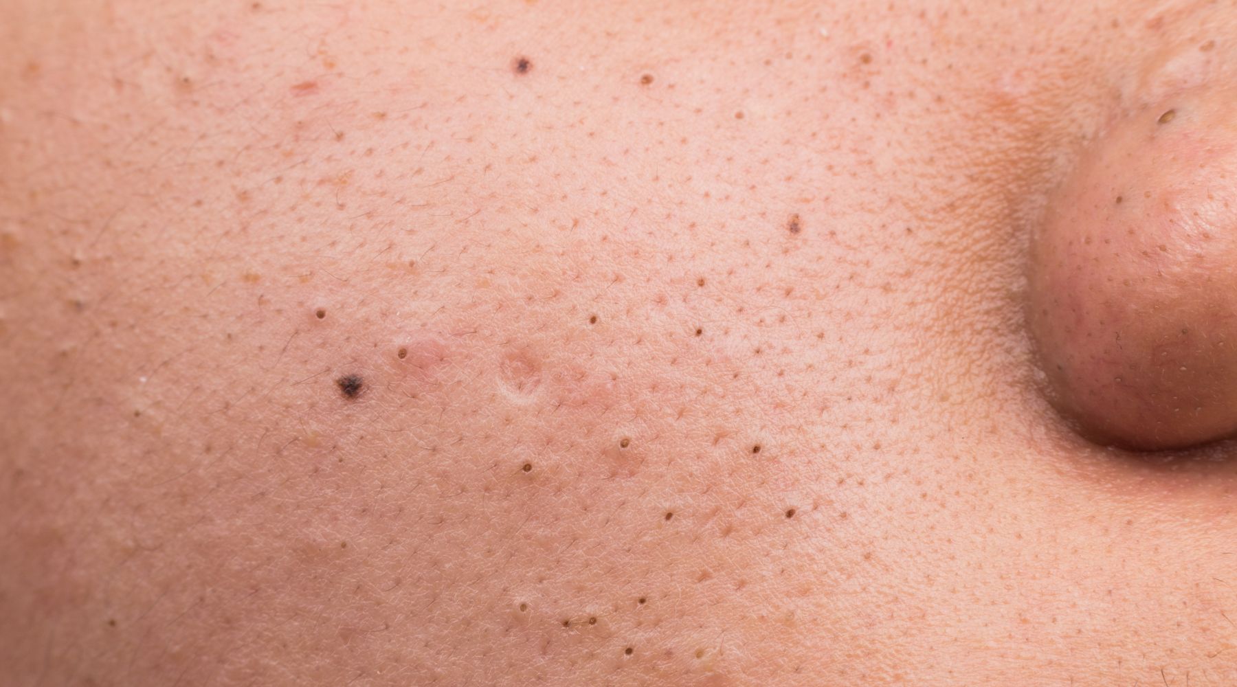 melhores tratamentos para cravos resistentes