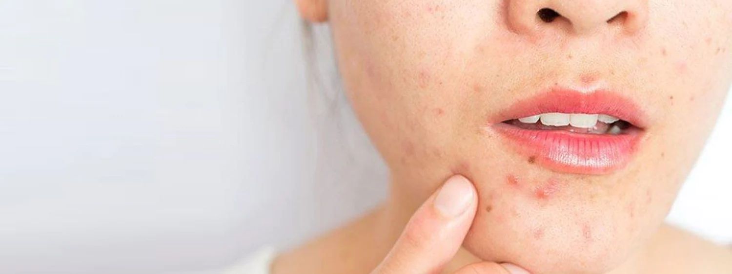 como tratar cravos pretos persistentes no queixo