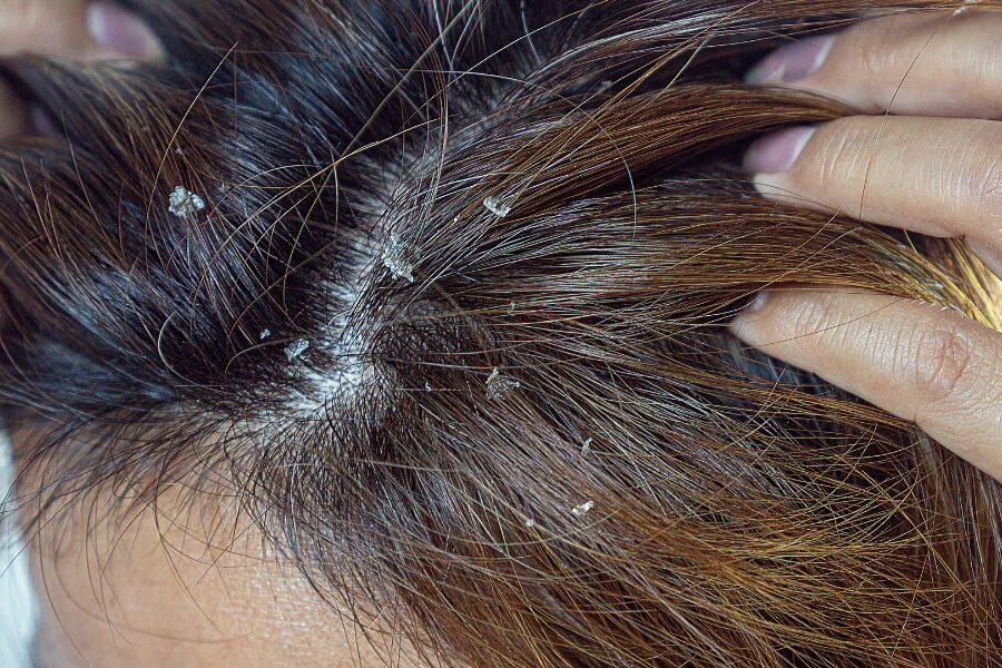 Como tratar dermatite seborreica no couro cabeludo
