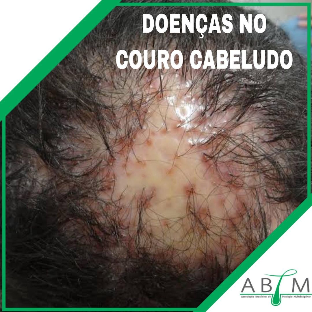 Como o Estresse Afeta a Dermatite Seborreica e Como Gerenciá-lo