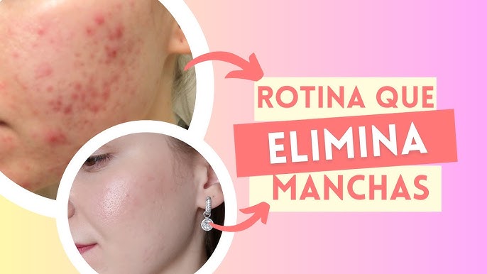 Como tratar manchas vermelhas de acne