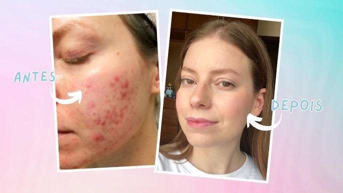 Como tratar manchas vermelhas de acne
