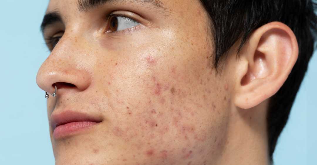 Como tratar manchas vermelhas de acne