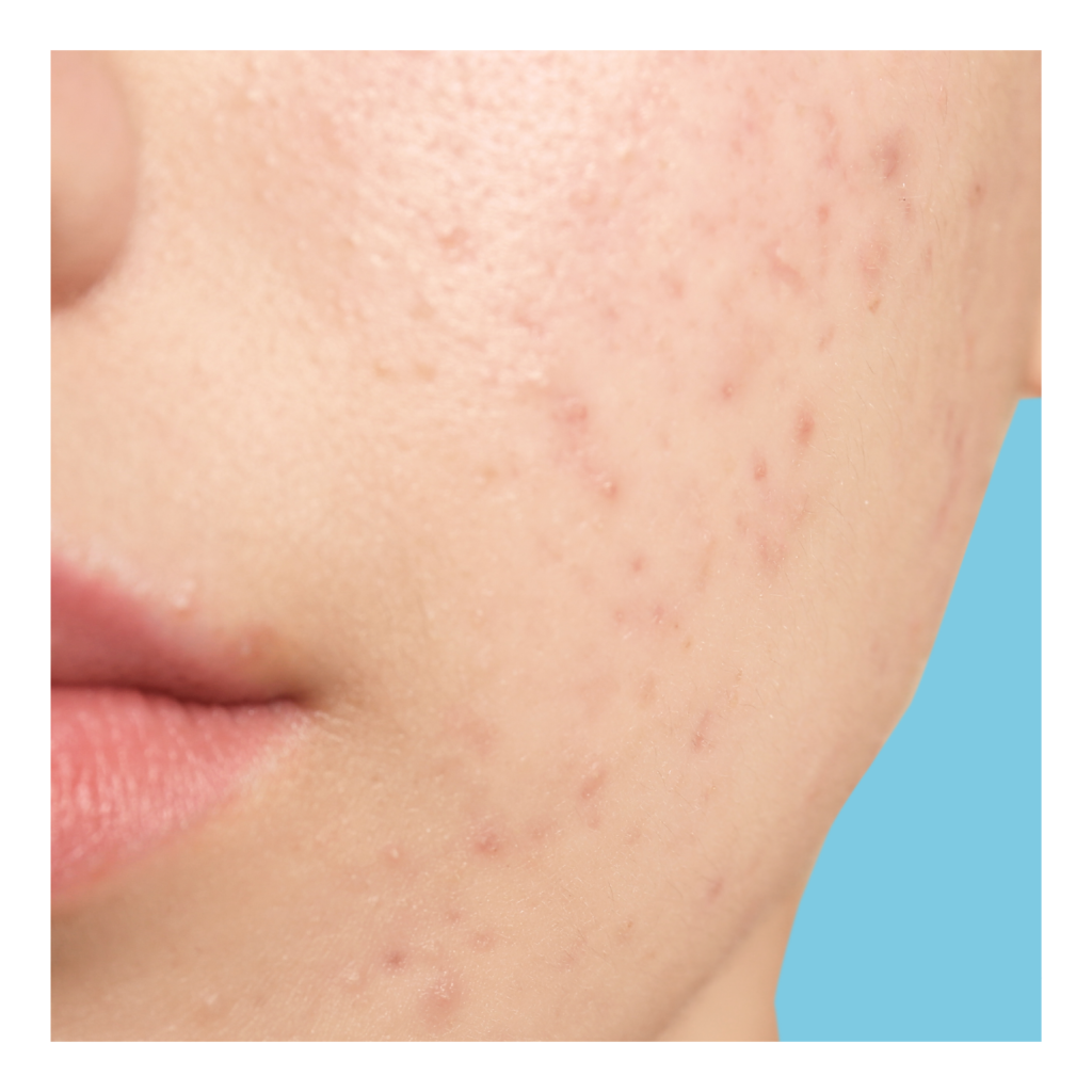 Como tratar manchas vermelhas de acne