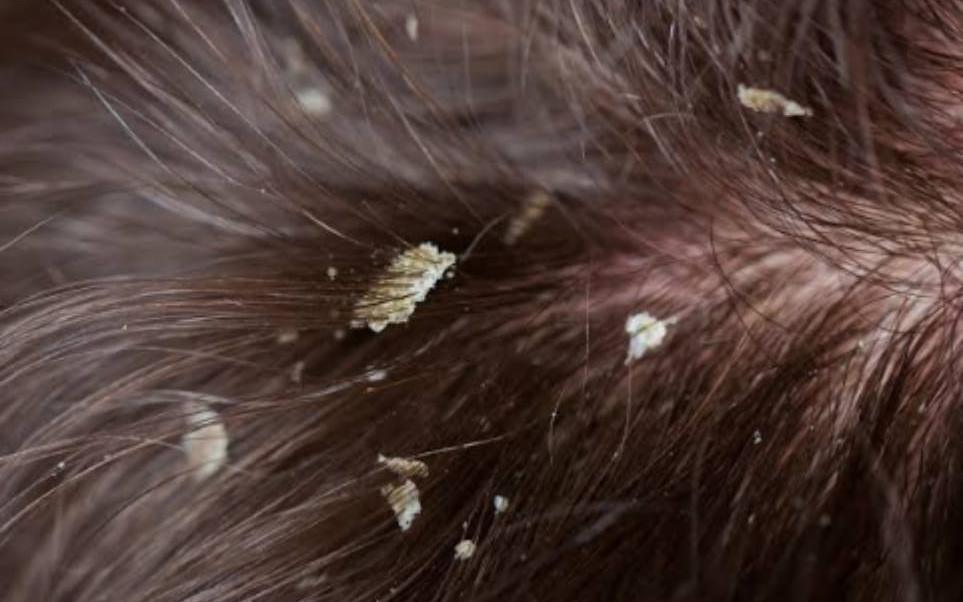 Como tratar o couro cabeludo ressecado e com descamação