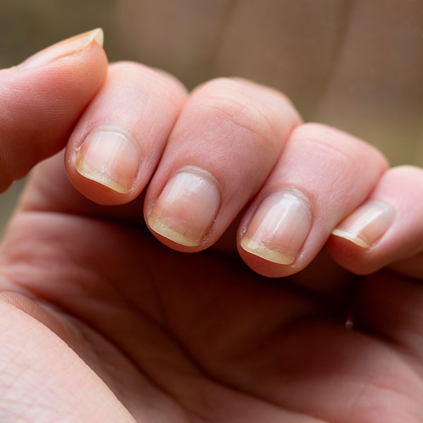 5 Receitas Caseiras Infalíveis para Clarear Unhas Amareladas