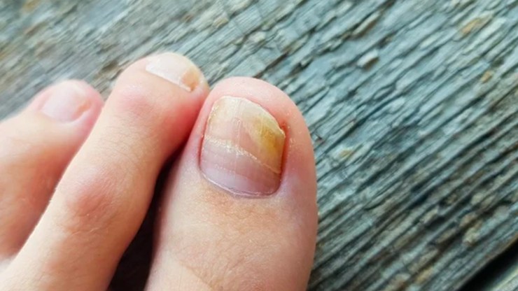 Unhas Amareladas: Quando é Hora de Procurar um Dermatologista?