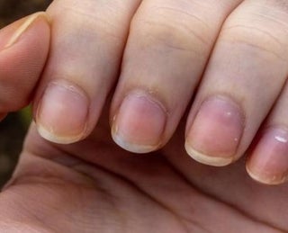 Como tratar unhas amareladas por causa de esmalte