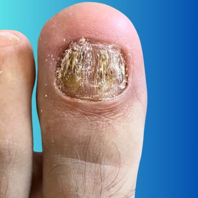 5 Melhores Esmaltes Antifúngicos para Micose de Unha