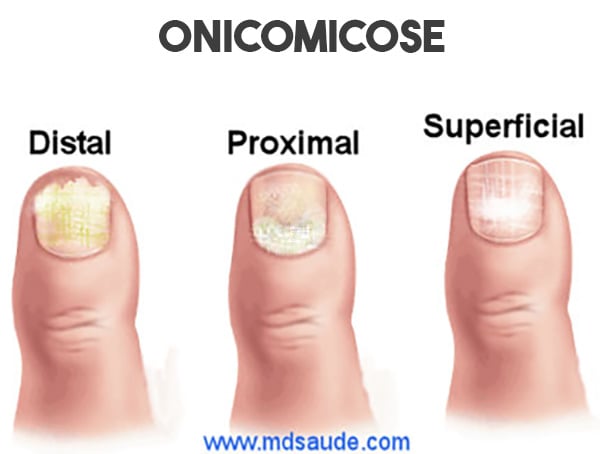 Remédios Caseiros para Micose de Unha: O Que Realmente Funciona?