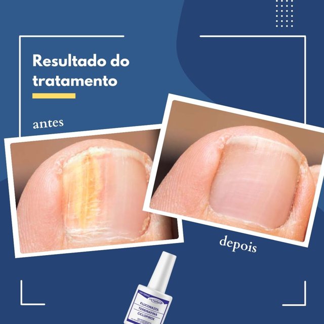 Como tratar unhas com fungos e micose rapidamente