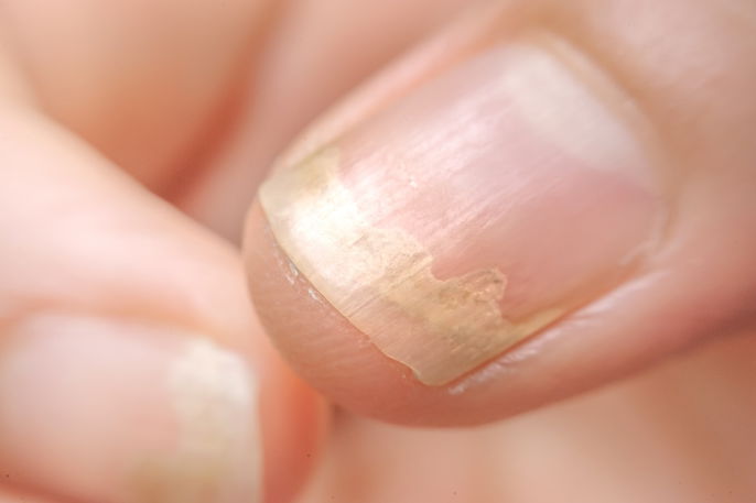 5 Melhores Esmaltes Antifúngicos para Micose de Unha