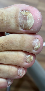 Remédios Caseiros para Micose de Unha: O Que Realmente Funciona?