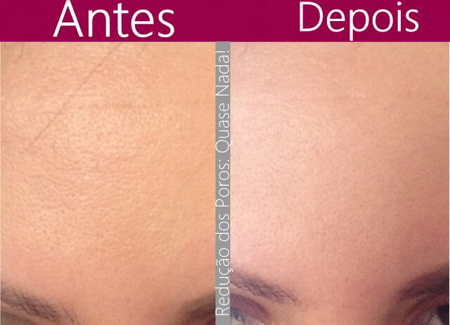 técnica de aplicação de primer para poros