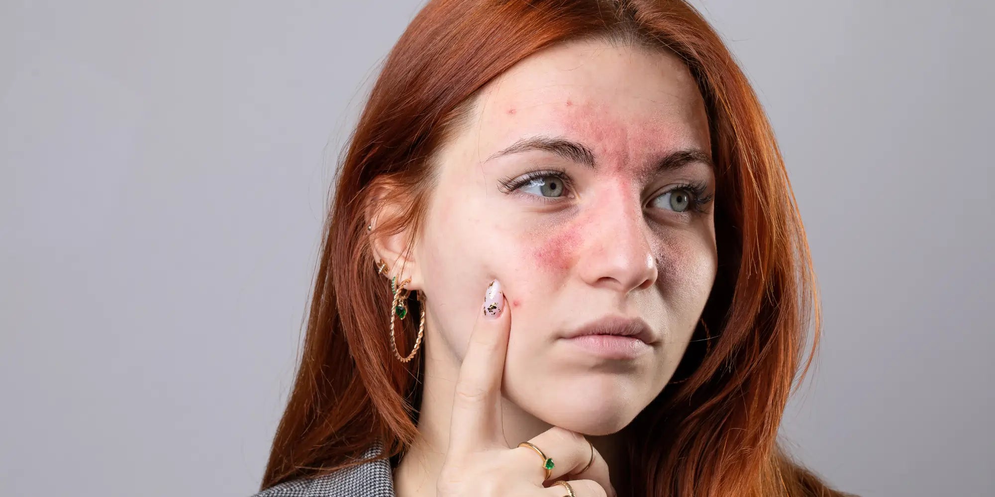 como maquiar pele com rosácea