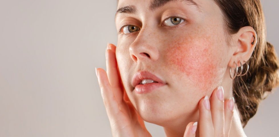 melhores bases para pele sensível com rosácea