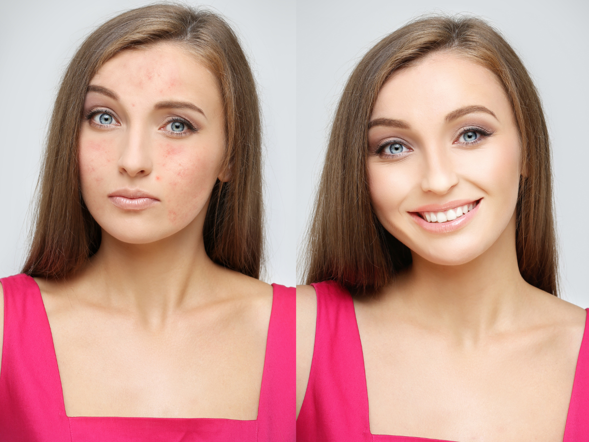 Guia de maquiagem para pele com rosácea