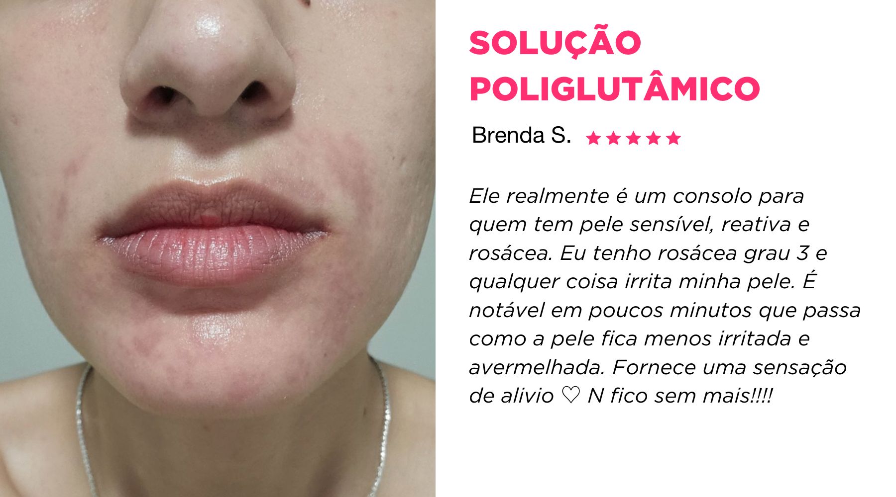 maquiagem para disfarçar vermelhidão rosácea