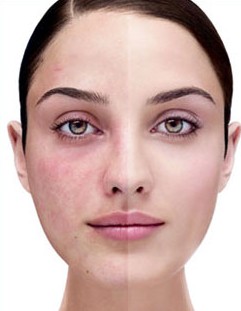 melhores bases para pele sensível com rosácea