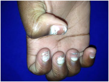manchas brancas nas unhas causas