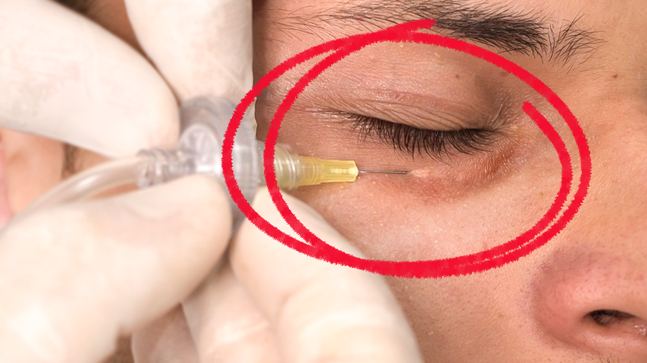 Melhores tratamentos para olheiras profundas e escuras