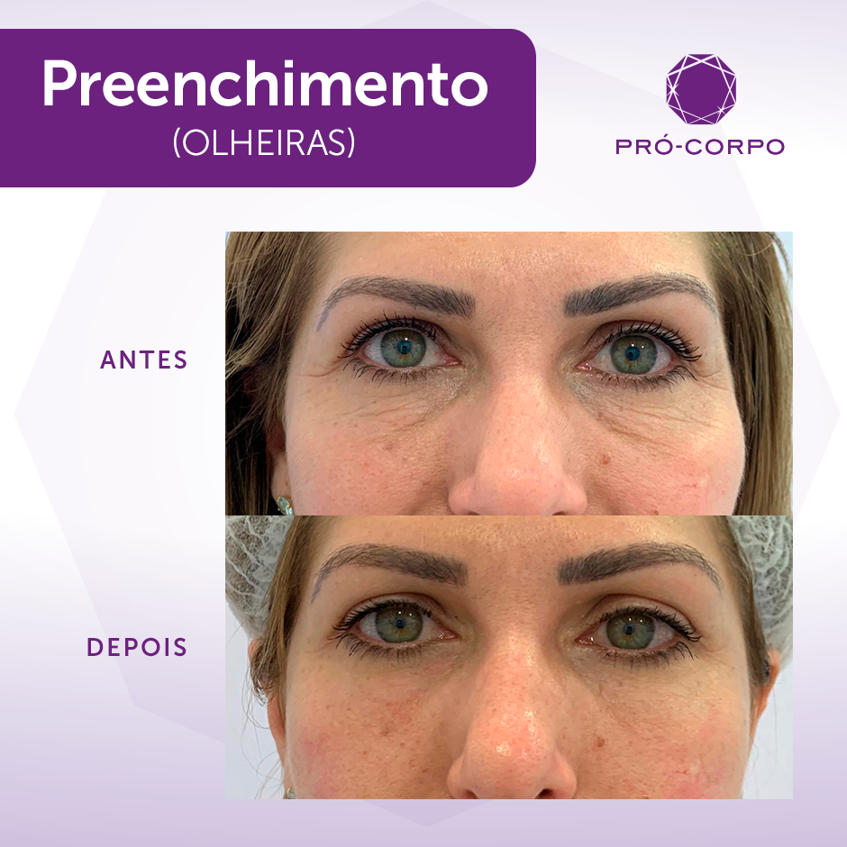 tratamento olheiras profundas preço