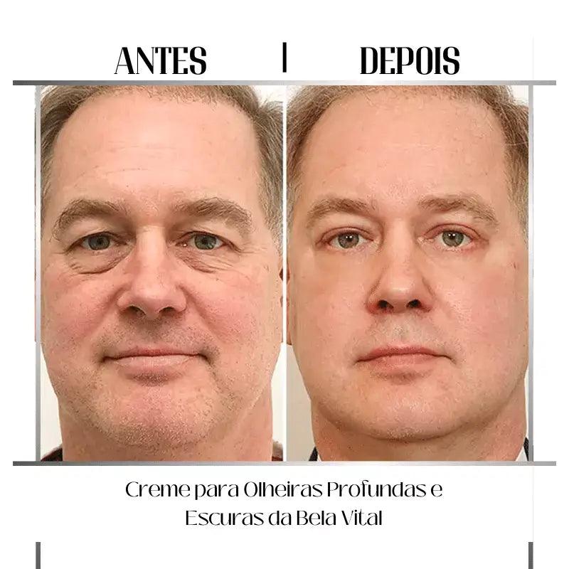 Melhores tratamentos para olheiras profundas e escuras