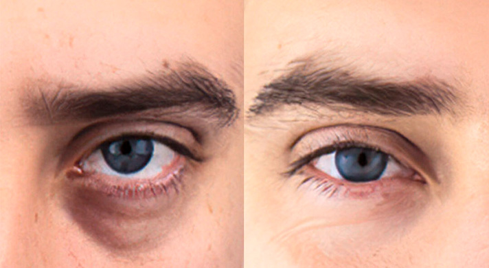 tratamento olheiras profundas preço