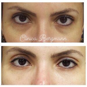 custo preenchimento olheiras ácido hialurônico