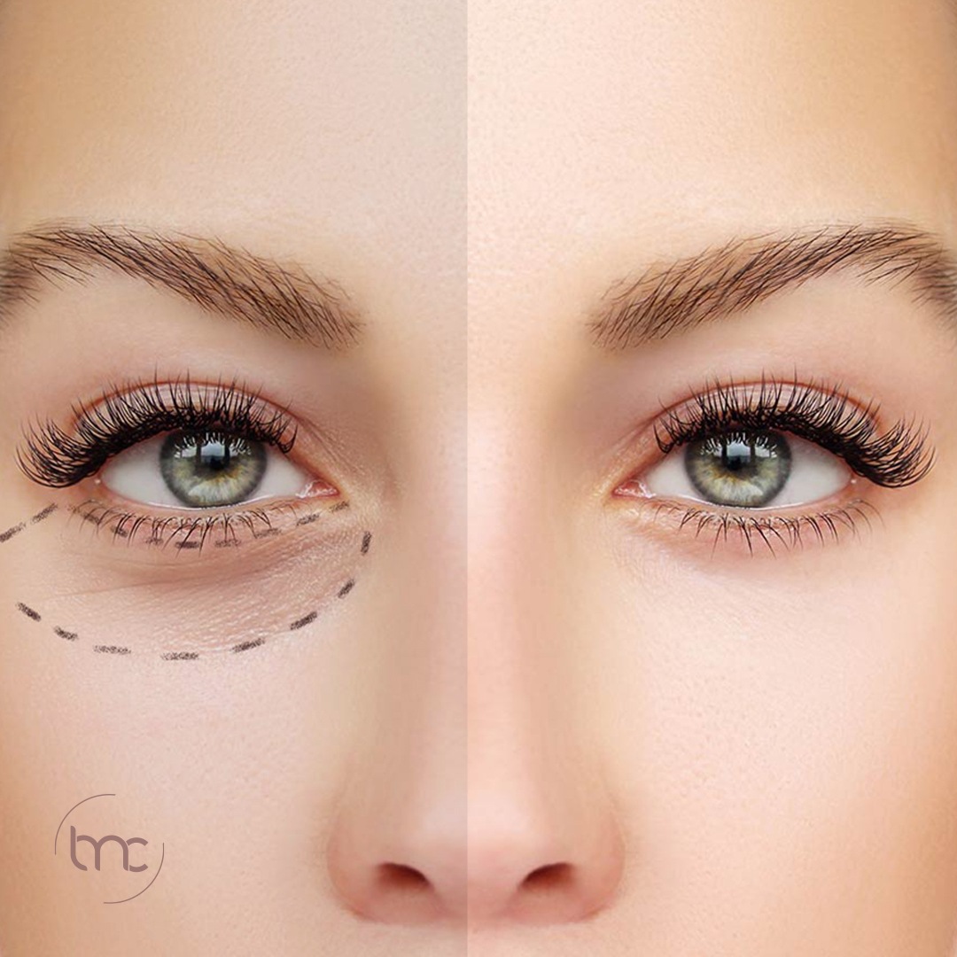 creme para olheiras pigmentares